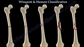 Fractures Of The Femur Shaft Winquist amp Hansen  Everything You Need To Know  Dr Nabil Ebraheim [upl. by Elletsirk626]