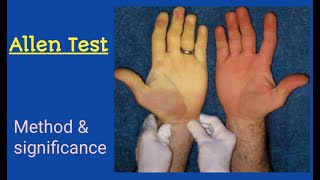 Allens test Allen test in Health assessmentin Urdu Hindi [upl. by Verdha]