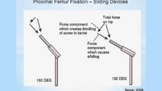 Biomechanics of Hip Osteotomies [upl. by Lonergan617]