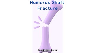 Humerus Shaft Fracture  Cause and Management [upl. by Eyahs]