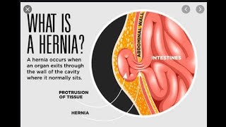 EVERYTHING YOU WANT TO KNOW ABOUT A HERNIA [upl. by Onitsuj]