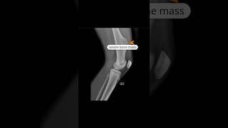 Osteochondroma  sessile xray knee shortfeed [upl. by Etnemelc620]