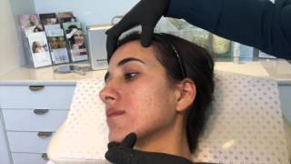 Dermapen Skin Needling for Acne amp Scarring [upl. by Fronniah]