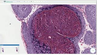 Molluscum Contagiosum  Histopathology [upl. by Selokcin]