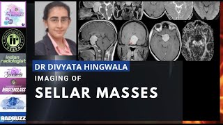 IMAGING OF SELLAR MASSES  DR DIVYATA HINGWALA  MRI TEACHING COURSE  PITUITARY MICROADENOMA [upl. by Bunce]