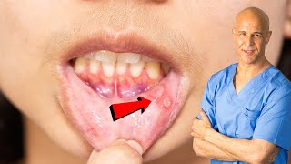 How I Quickly Healed My Canker Sore  Dr Mandell [upl. by Weiss864]