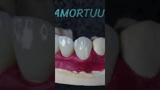 anatomy exocad implants stomatology zro2 emaxveneers emaxpress dentist design tooth [upl. by Sanyu416]