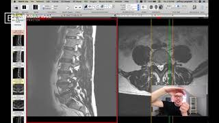 Clinical Series How to See a Pinched Nerve Foraminal Stenosis on MRI [upl. by Anaeli]