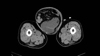 Case 7 73 year old male patient with abdominal pain [upl. by Feirahs]