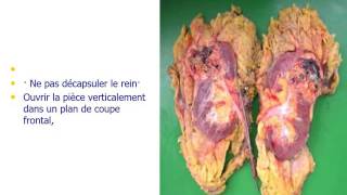 UROLOGIE Anatomie Pathologie du Rein [upl. by Sill]