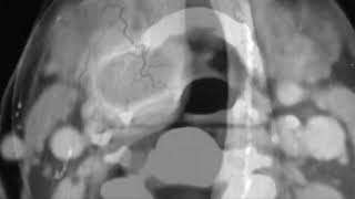 SACCULAR CYSTLARYNGOCELELARYNGEAL CYST DIFFERENCE [upl. by Pansie]