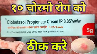 Clobetasol Cream use For एग्जिमा एलर्जी Damataitisskin rashes  soriasis  Review in hindi [upl. by Nailluj]