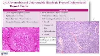 Thyroid carcinoma I Pathology evaluation [upl. by Olcott]