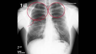 Pneumothorax Radiology in two minutes [upl. by Odey]