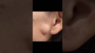 Cheeky cyst  full video tagged to watch the sac removal and a bonus blackhead drpimplepopper [upl. by Bealle]