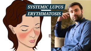 SLE  Systemic Lupus Erythematosus [upl. by Erihppas]