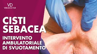 CISTI SEBACEA intervento ambulatoriale di svuotamento [upl. by Vanessa]