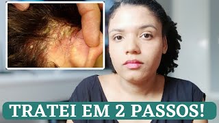 NUNCA MAIS TIVE DERMATITE DEPOIS DESSES CUIDADOS [upl. by Espy]