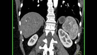 Abdomen Liver Hemangioma of the Liver2 of 8 [upl. by Aztinad]