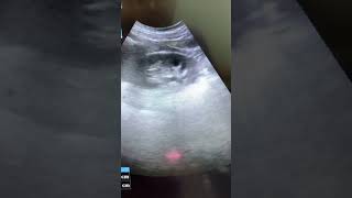 Left renal calculus ultrasound [upl. by Wymore329]