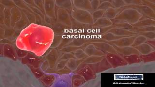 Basal Cell Carcinomas Medical Animation Video 3D [upl. by Nairdna]