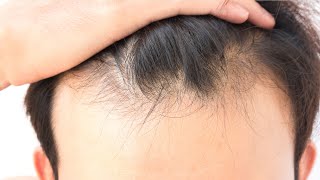 How many FUE hair grafts do I need to restore my hairline [upl. by Ileray]