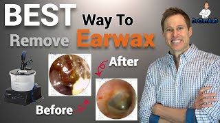 The BEST Way to Professionally Remove Earwax  Earigator Cerumen Irrigation [upl. by Ruyam]