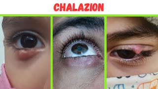 Chalazion  Photos Causes Diagnosis and Treatment [upl. by Yovonnda]