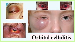 orbital cellulitis [upl. by Tjader]