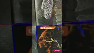 Embolization of renal angiomyolipoma with emboguide software [upl. by Odella]