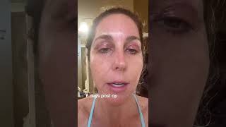 Eyelid surgery recovery  blepharoplasty  6 days after upper lid surgery [upl. by Airogerg157]