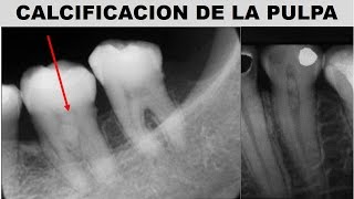 quotCALCIFICACIÓN DE LA PULPA UN DESAFÍO EN ENDODONCIAquot por la Dra Laura Taiman [upl. by Roybn]