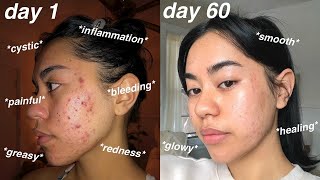 I CLEARED MY ACNE 60 days using Differin Gel Adapalene 01  pictures [upl. by Richela921]