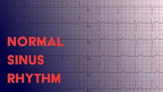 Normal Sinus Rhythm  EKG ECG Interpretation [upl. by Holmann]