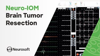 Intraoperative monitoring in brain tumor resection  NeuroIOM [upl. by Esenej]