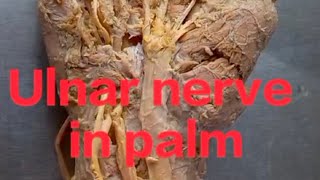 Ulnar nerve in Palm Nerve of hand Anatomy of ulnar nerve [upl. by Holder]