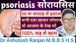 psoriasis ka ilaj 👉सोरायसिस को जड़ से खत्म करें 👉50 रुपये में👉क्यों नहीं ठीक होगा 💯 ठीक होगा [upl. by Ahtreb882]