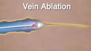 Varicose Vein Ablation amp Closure [upl. by Clemmy]