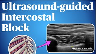 UltrasoundGuided Intercostal Nerve Block [upl. by Lenee]