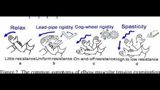 Difference between Cogwheel Rigidity and Lead Pipe Rigidity [upl. by Marmawke496]