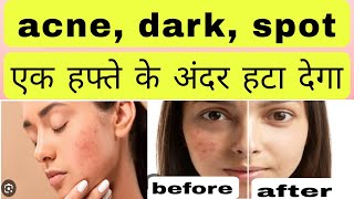 Cosmelite creamacne dark spot एक हफ्ते में हटा देगा uses in Hindi [upl. by Brenner541]