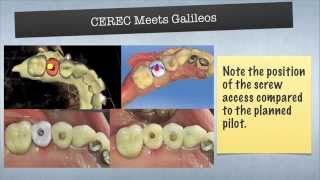 CEREC and Conebeam Integration Implant Case [upl. by Eiralam725]