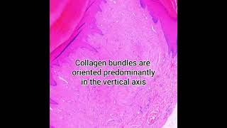 Histopathology of Acral Digital Fibrokeratoma pathology dermatopathology dermpath pathologist [upl. by Ddet]