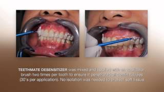 Desensitizing Procedure using the NEW TEETHMATE DESENSITIZER from Kuraray [upl. by Elata]