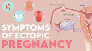 HEAVY SIGNS And SYMPTOMS Of ECTOPIC Pregnancy MOMMATTERS [upl. by Elleimac647]