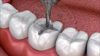 Basic Dental Restoration Cavity Filling  In English [upl. by Ahsaeym589]