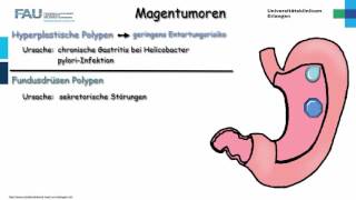 Pathologie ─ Magentumoren [upl. by Adiaz]