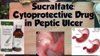 Sucralfate Cytoprotective Drug in Peptic Ulcer [upl. by Aires]