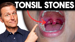 Tonsil Stones Removing the Deeper Cause [upl. by Eilrahc401]