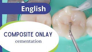 Composite onlay  part 5 final cementation [upl. by Dulce]